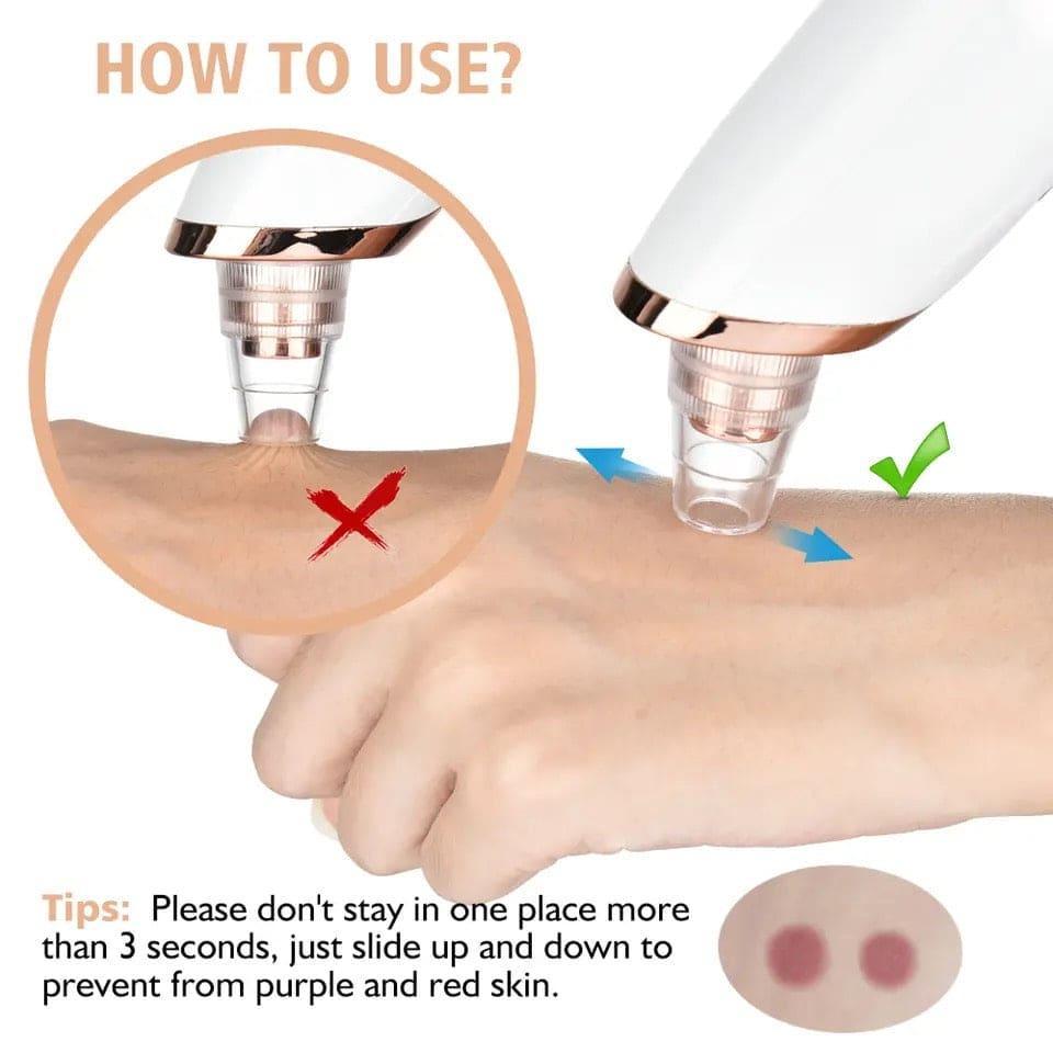 Battery Operated Blackhead Remover – Deep Pore Cleansing Tool